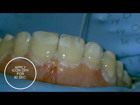 White spot treatment using infiltration with Icon - step-by-step