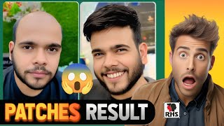 Bald to Bold 😱 Hair Patch Result | Before After Transformation | Ganjepan Ka Permanent Solution