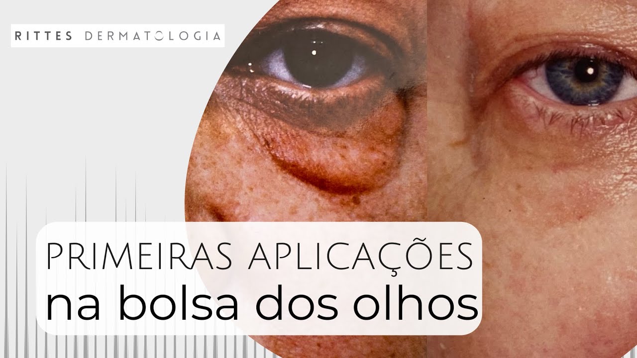 Como tratar bolsa abaixo dos olhos sem cirurgia
