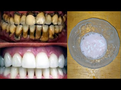 , title : 'Πώς να αφαιρέσετε την πέτρα σε 3 λεπτά χωρίς να πάτε στον οδοντίατρο'