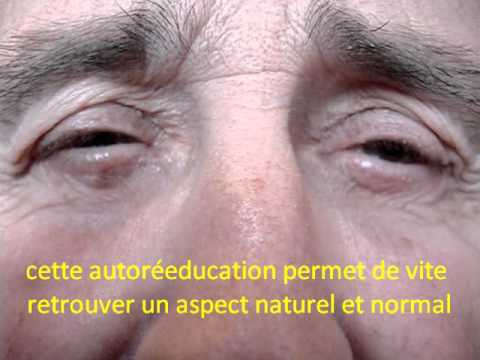 comment guerir les poches des yeux