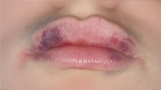 how to get rid of bruised lips from suction fast and easy