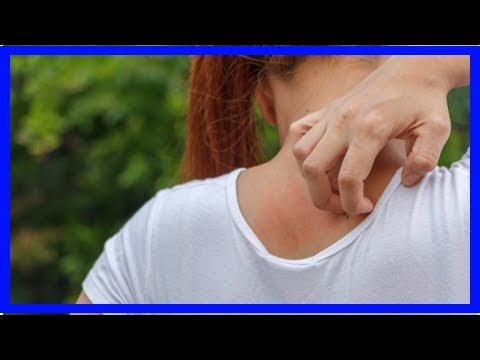 Cura di sporcizia di saksky di psoriasi Unguenti e gel per cura di psoriasi