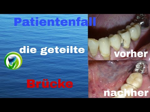 Patientenfall - Geschiebebrücke - geteilte Brücke im Unterkiefer | vorher - nachher