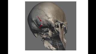 MUSCULOS CUELLO POSTERIOR: SEMIESPINOSO DE LA CABEZA