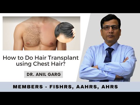 How to Do Hair Transplant using Chest Hair? | Hair...