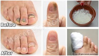 Do you suffer from nail fungus? You have to do this!!!! *** VERY IMPORTANT TIP ***