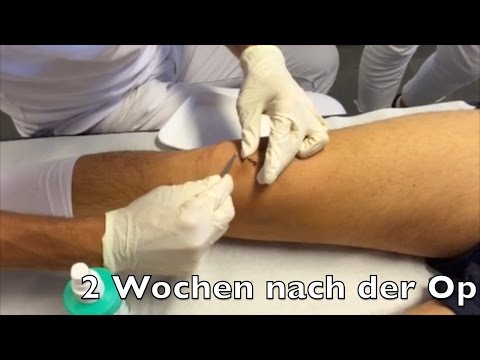 Kniepolster zur Fixierung des Kniegelenks mit Arthrose kaufen Schmerzen in den Gelenken des Videos zu sehen
