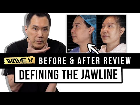 Face Lift Before & After Review: How to Tighten the Jawline and look Natural | Wave Plastic Surgery