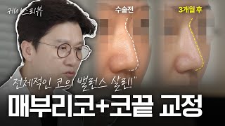 “매부리+비주+미간꺼짐 개선했어요” 무보형물 코성형 5개월 변화 | 자연스러운 코라인 교정 케이스리뷰