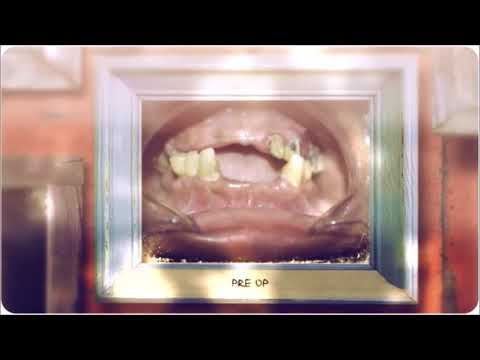 Dental Implants completed  in 72 Hours by dental specialist in coimbatore