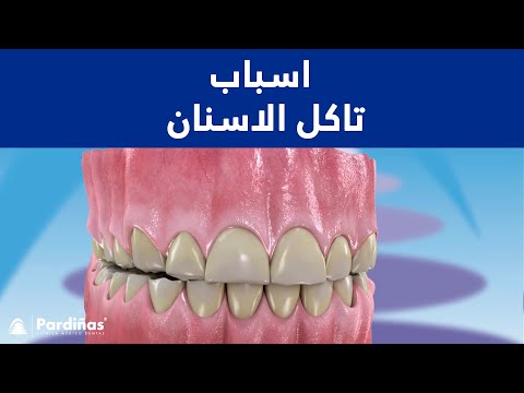 © اسباب تاكل الاسنان