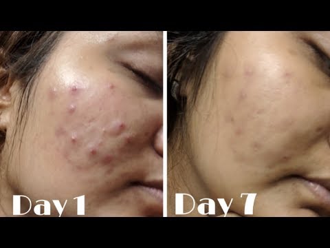 download lagu mp3 mp4 Does Ice Actually Help Pimples, download lagu Does Ice Actually Help Pimples gratis, unduh video klip Does Ice Actually Help Pimples