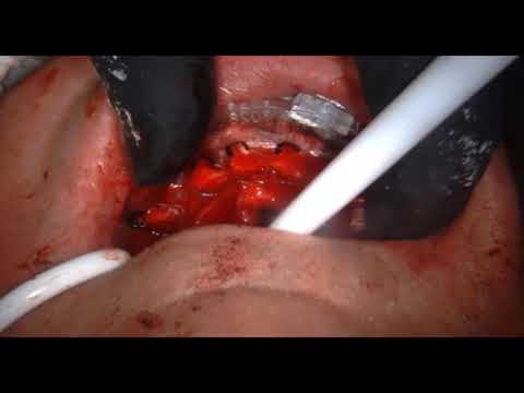 Chrome™ Full Arch Guided Smile