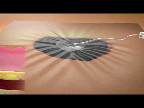 3M™ V.A.C.® Therapy System Mechanism of Action