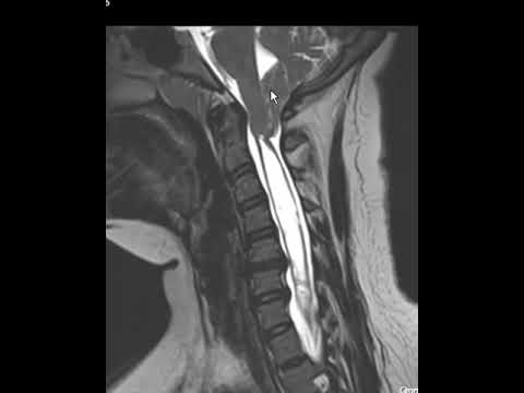 Chiari I malformation with large syrinx