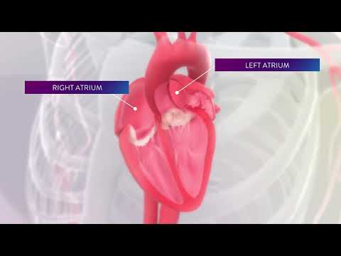 Left Atrial Appendage Occluders Reduce Risk of Stroke in AFib Patients