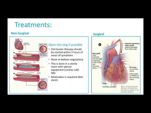 In Control Webinar 1 - The Basics of Heart Failure