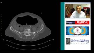 CT of Cecal Volvulus and Complications by Dr Arjun Kalyanpur CT of Cecal Volvulus and Complications by Dr Arjun Kalyanpur