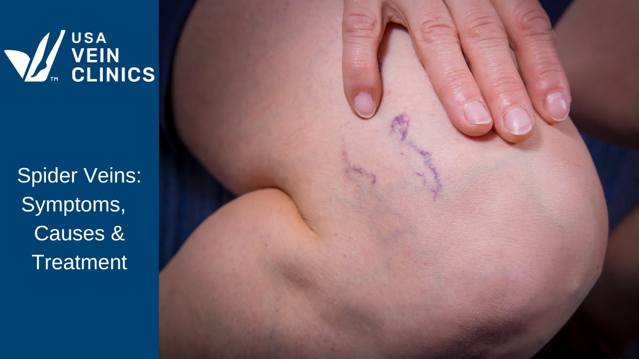 Why am I getting spider veins so quickly? More REF