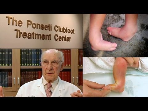 A Walking Miracle - The Ponseti Method for Clubfoot Treatment