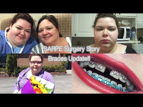 My Braces Story - Episode 2 ♡ SARPE SURGERY