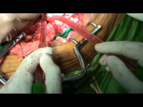 Reparación de aneurisma aórtico abdominal infrarrenal