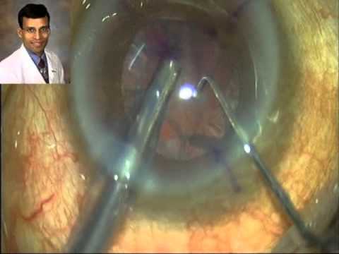 How To Implant Toric IOL in a Small Pupil