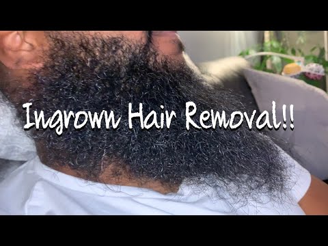 The Most Satisfying Ingrown Hair Removal From Beard!!