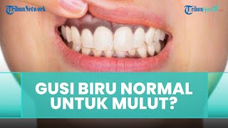 Apakah Gusi Kebiruan hingga Kehitaman itu Normal untuk Kesehatan Mulut? Simak Ulasan drg. Anastasia