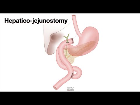 HCC 1475-10g-Surgical Anatomy-Hepaticojejunostomy