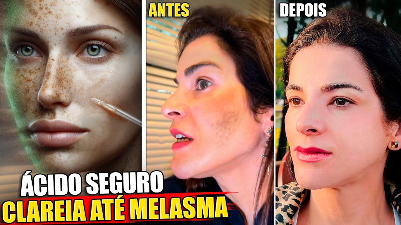 Use para Clarear Manchas de Pele, Inclusive Melasma, manchas nas axilas e virilha!