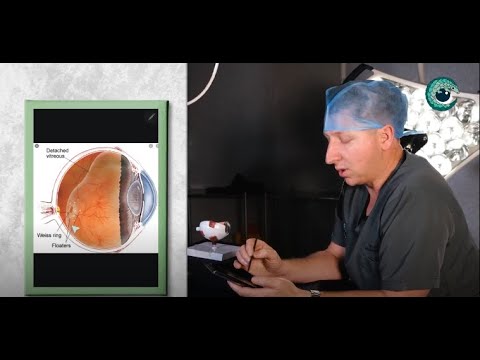 Floater Removal Surgery: What You Need to Know | Dr. Dean van der Westhuizen