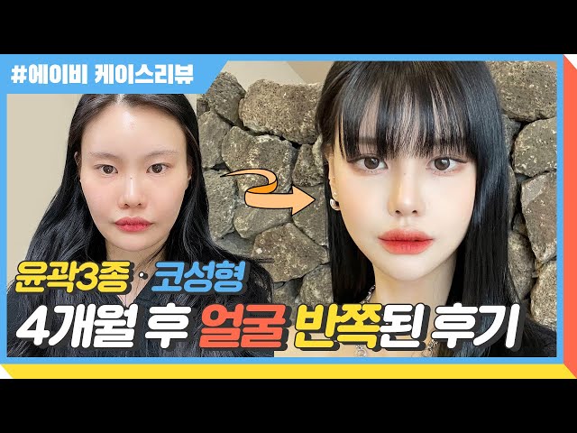 에이비성형외과의원_코성형_매부리코 에이비성형외과의원_코성형_매부리코