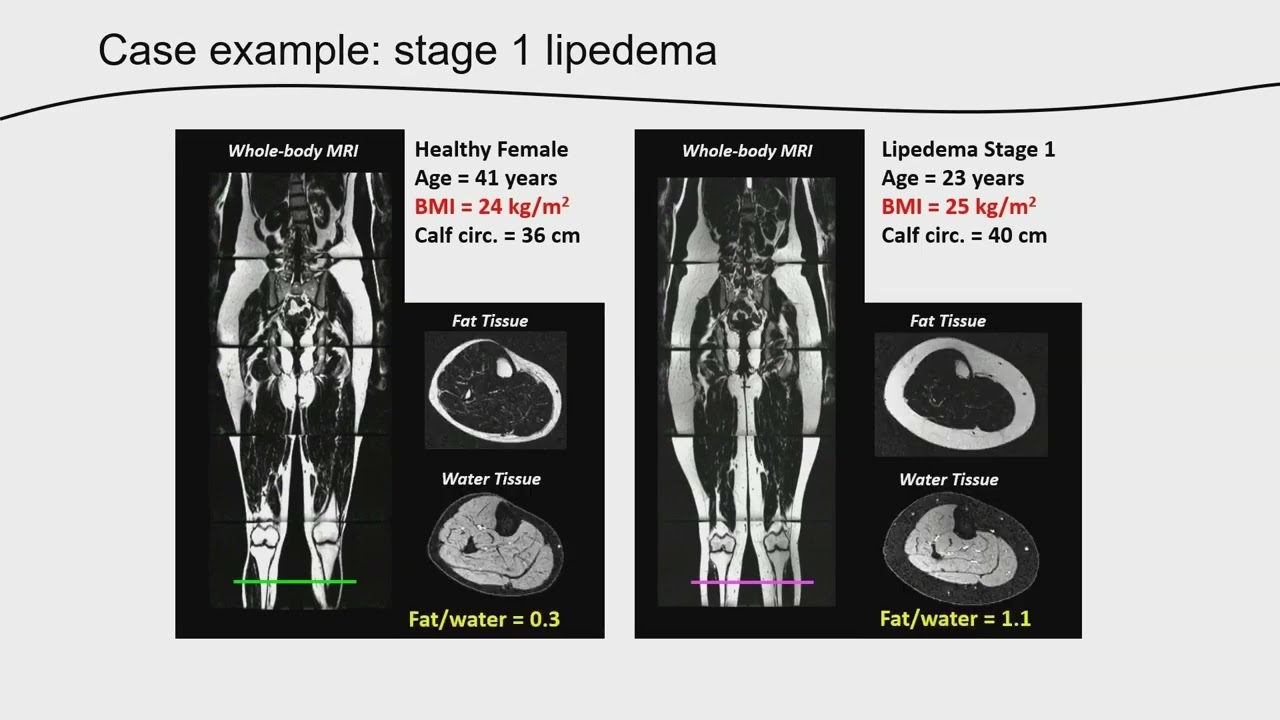 Imaging: Lipedema