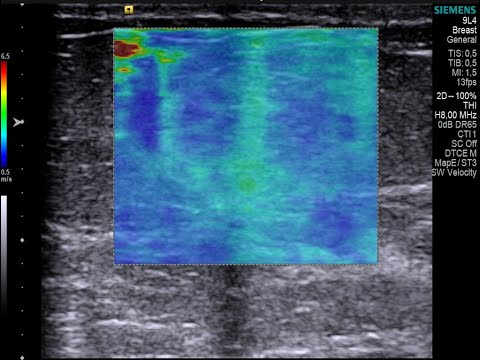 Lipoma na mama. Entenda a elastografia e aprenda a diferenciá-lo do hamartoma.