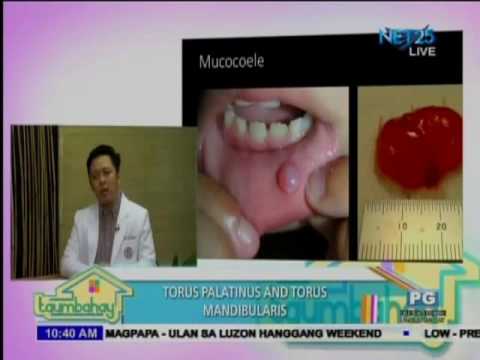 Antifungals Nail Treatments Mummy itinuturing ng kuko halamang-singaw