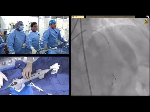(20 min CCC March '19) OCT Guided Multi Vessel PCI using Orbital Atherectomy