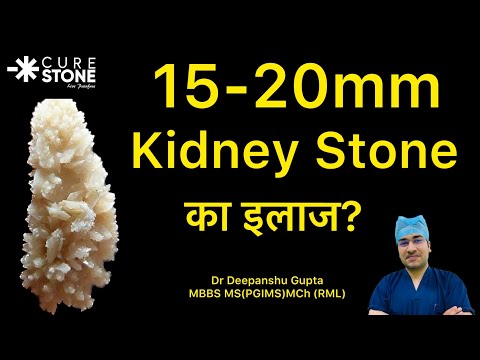 15-20mm Kidney Stone का इलाज कैसे होता है?? Treatment for 15-20 mm Kidney stones (In Hindi)
