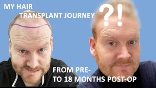 My hair transplant journey: from pre- to 18 months after