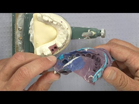 Chairside Live Episode 134: Two Implants Too Close Together