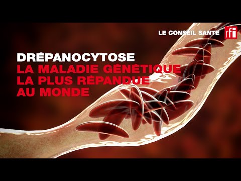 Conseil Santé : l'anémie est le premier signe de la drépanocytose