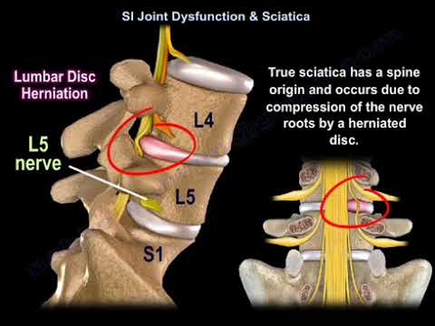 Disfunción de la articulación sacroilíaca versus ciática: comprensión del dolor en la articulación sacroilíaca que se asemeja al dolor de la columna y la ciática