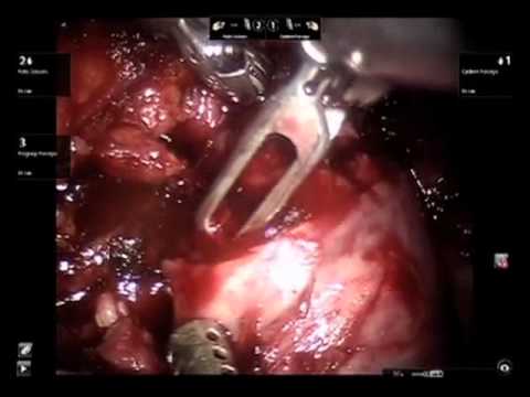 Robotic Radical Nephrectomy with Resection of Inferior Vena Cava