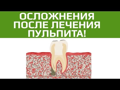 Осложнения после лечении пульпита. Плохо пролечены каналы зуба