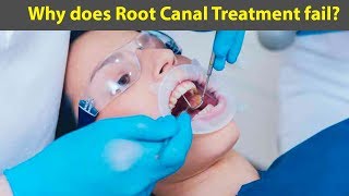 This Is The Reason Why, Dentist Refused To Perform Root Canals For Over 20 Years- BY Healthy Ways