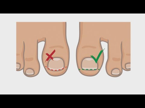 How to Best Handle and Treat an Ingrown Toenail