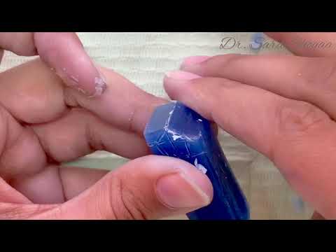 Carving of the upper canine ( step 1)