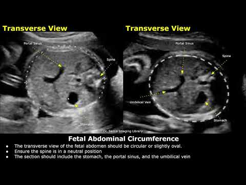 How To Measure Fetal Abdominal Circumference (AC) On Ultrasound | Fetal Biometry | Obstetric USG