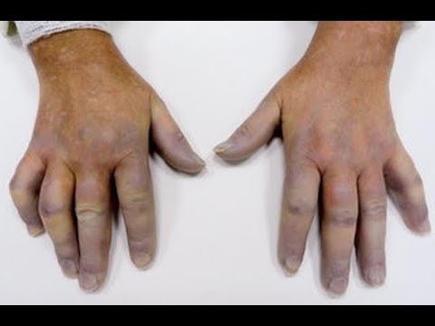 Valgus deformacja leczenia stawu biodrowego Kości po stronie stóp małego palca